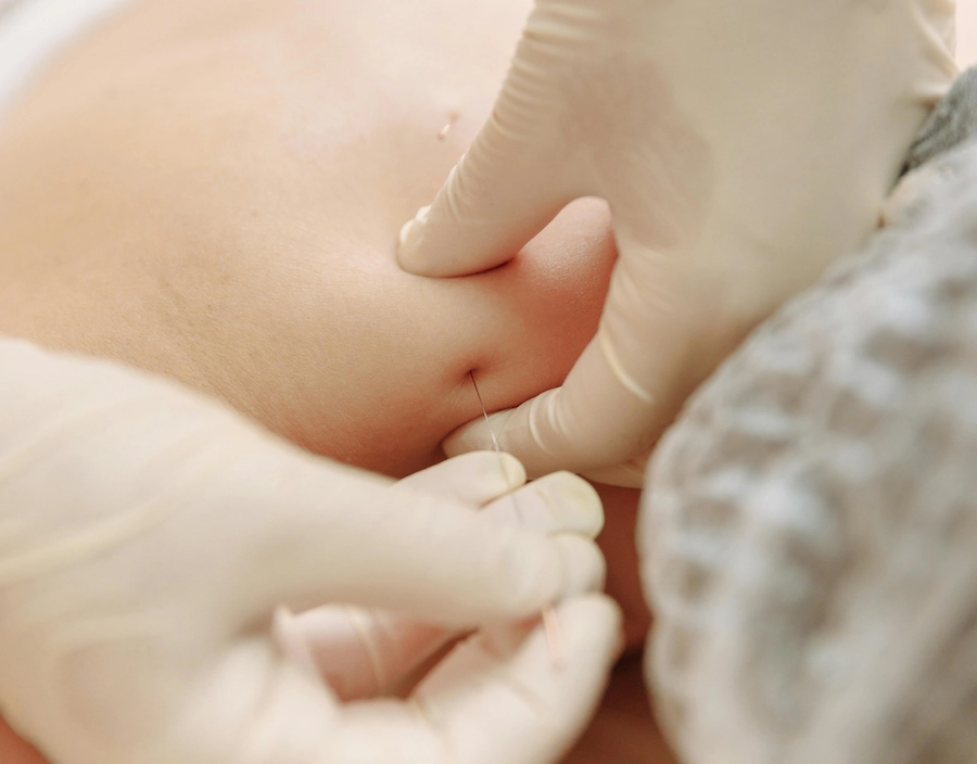 Le Dry Needling